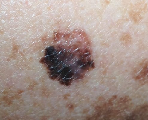 Types Of Skin Cancer London - Melanoma